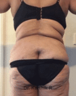 Liposuction Tummy and Back