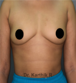 Breast Implants (Breast Augmentation)