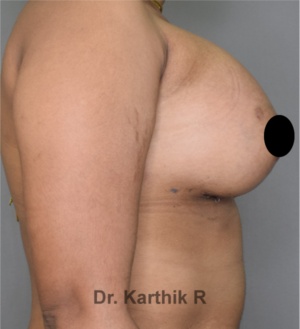 Breast Implants (Breast Augmentation)