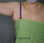 Axillary Tail of Breast