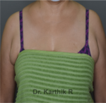 Axillary Tail of Breast