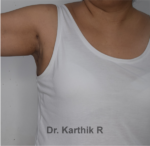 Axillary Tail of Breast