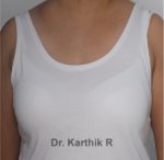 Axillary Tail of Breast