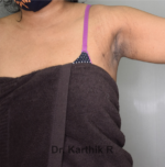 Axillary Tail of Breast