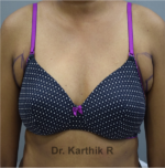 Axillary Tail of Breast