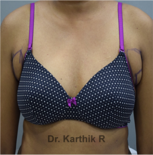 Axillary Tail of Breast