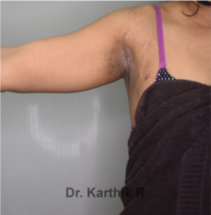 Axillary Tail of Breast