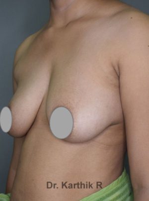 Breast Implants (Breast Augmentation)