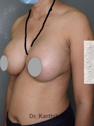 Breast Implants (Breast Augmentation)