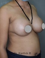Breast Implants (Breast Augmentation)