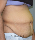 Tummy Tuck