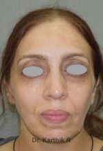 Fat Graft / Fat Fill/ Fat Transfer