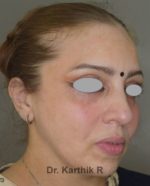 Fat Graft / Fat Fill/ Fat Transfer