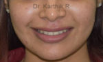 Dermal Fillers