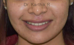 Dermal Fillers