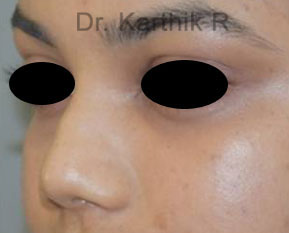 Dermal Fillers