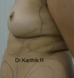 Breast Fat Fill (Breast Augmentation)