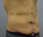 Tummy Tuck