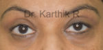Blepharoplasty