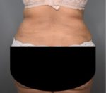 Vaser Liposuction