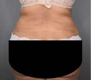 Vaser Liposuction