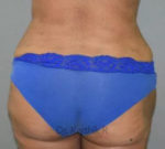 Liposuction Tummy and Back