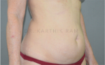 Liposuction Tummy and Back
