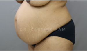 Tummy Tuck