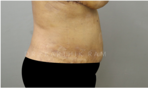 Tummy Tuck