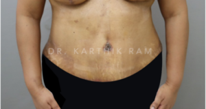 Tummy Tuck