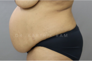 Tummy Tuck