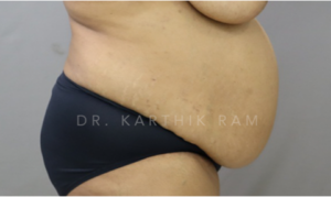 Tummy Tuck