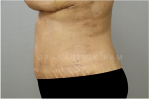 Tummy Tuck